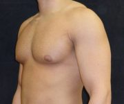 before Gynecomastia case 3506 side view