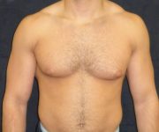before Gynecomastia case 3506 front view