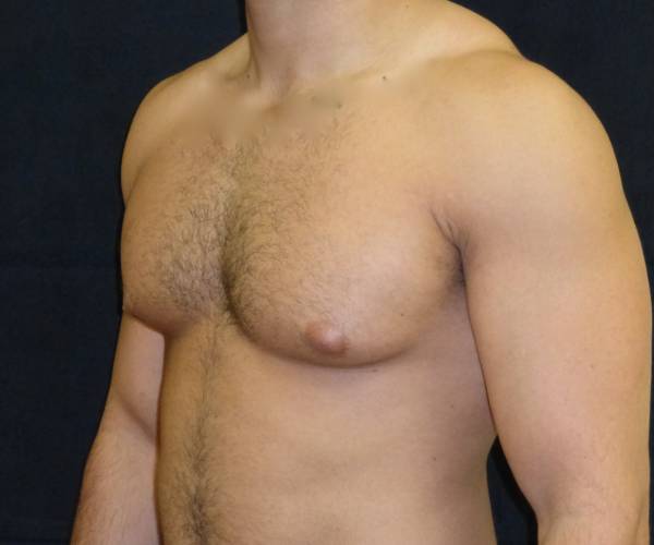 before Gynecomastia case 3506 angle view