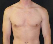 after Gynecomastia case 3511 front view