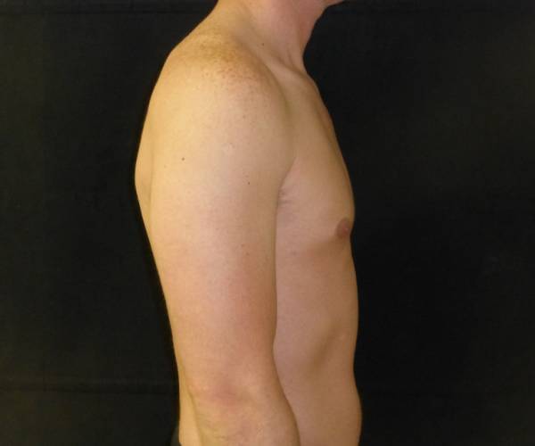 after Gynecomastia case 3511 side view