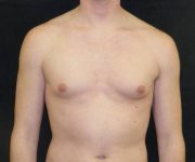 before Gynecomastia case 3511 front view