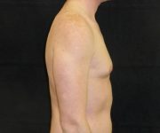 before Gynecomastia case 3511 side view