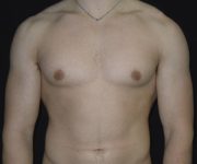 after Gynecomastia case 3521 front view