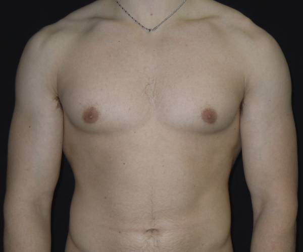 after Gynecomastia case 3521 front view