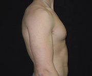 after Gynecomastia case 3521 side view