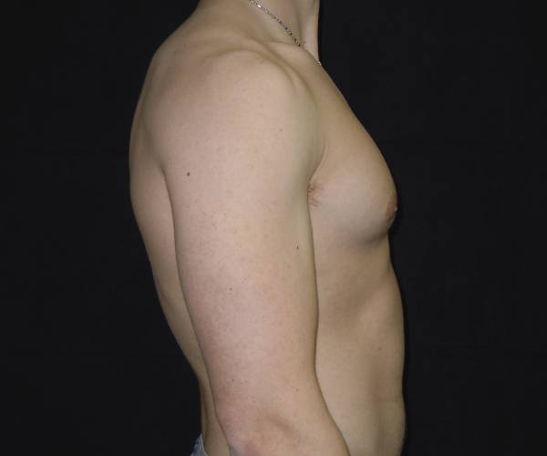 after Gynecomastia case 3521 side view