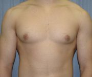 before Gynecomastia case 3521 front view