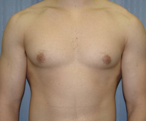 before Gynecomastia case 3521 front view