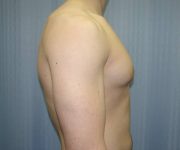 before Gynecomastia case 3521 side view