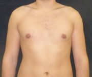 after Gynecomastia case 3526 front view