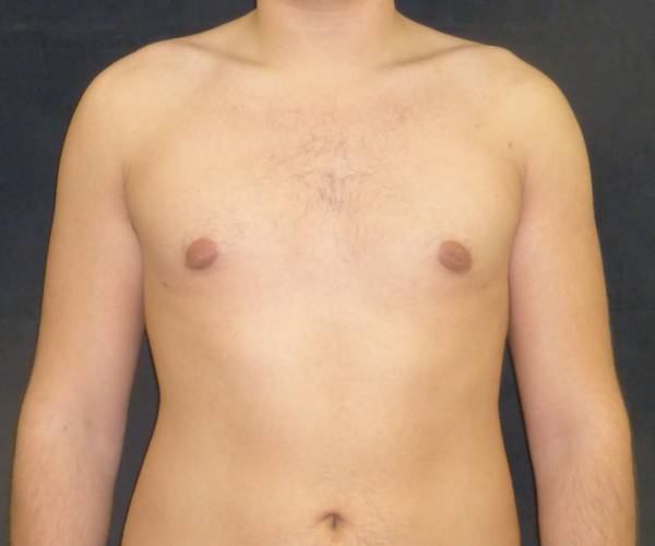 after Gynecomastia case 3526 front view