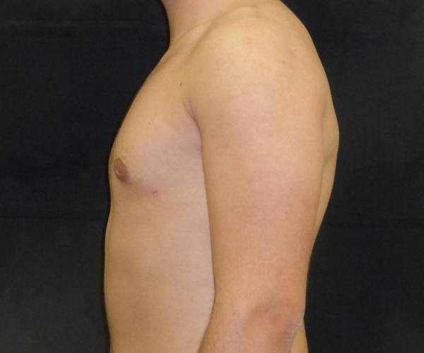 after Gynecomastia case 3526 side view