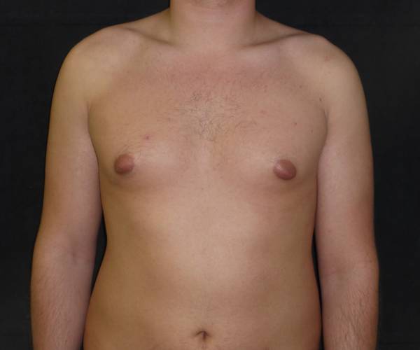before Gynecomastia case 3526 front view