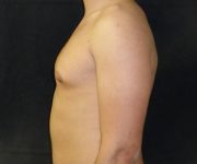 before Gynecomastia case 3526 side view