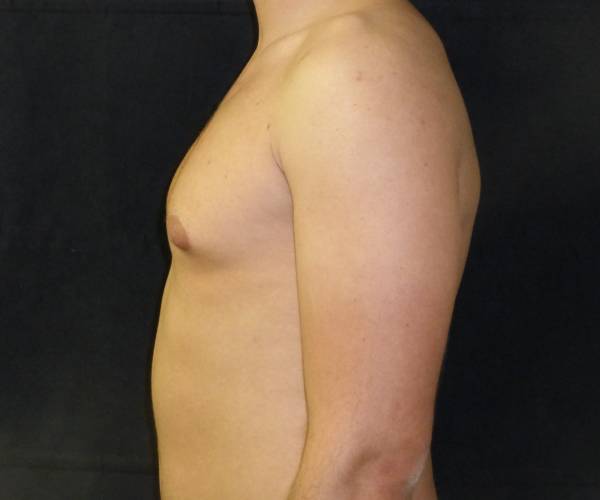 before Gynecomastia case 3526 side view