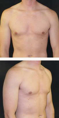 after Gynecomastia case 3551 front and angle view