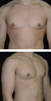 after Gynecomastia case 3554 front and angle view