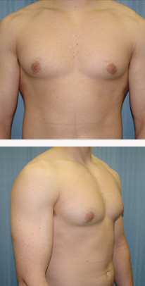 before Gynecomastia case 3554 front and angle view