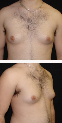 before Gynecomastia case 3557 front and angle view