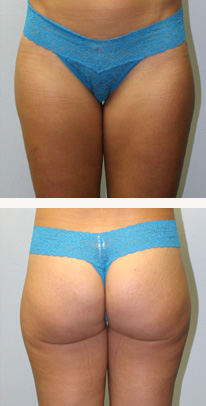 after liposuction female patient front & back view case 3326