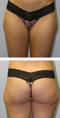 before liposuction female patient front & back view case 3326