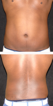 after liposuction male patient front & back view case 3329