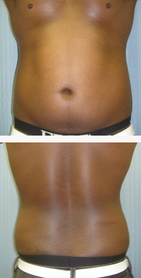 before liposuction male patient front & back view case 3329