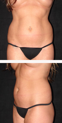 before liposuction female patient front & side view case 3334