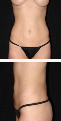 after liposuction female patient front & side view case 3337