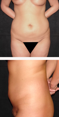before liposuction female patient front & side view case 3337