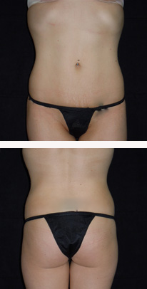 after liposuction female patient front & back view case 3340