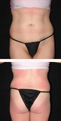 before liposuction female patient front & back view case 3340