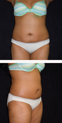 after liposuction female patient front & angle view case 3343