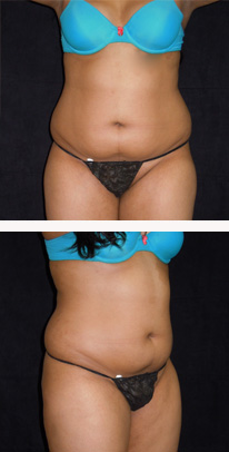 before liposuction female patient front & angle view case 3343