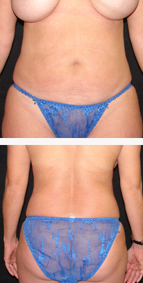 after liposuction female patient front & back view case 3347