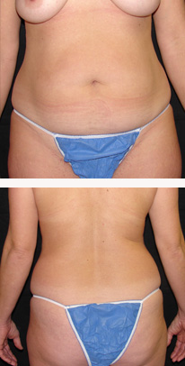 before liposuction female patient front view case 3346