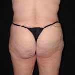 after body lift back view female patient case 4279