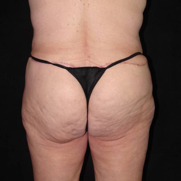 after body lift back view female patient case 4279