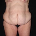 before body lift front view female patient case 4279