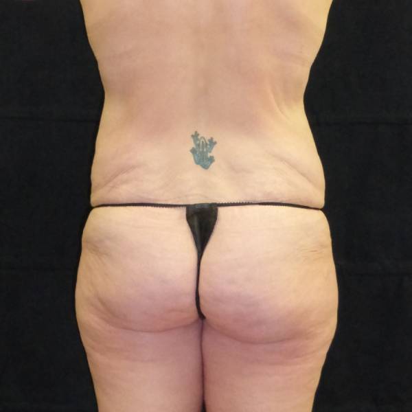 before body lift back view female patient case 4289
