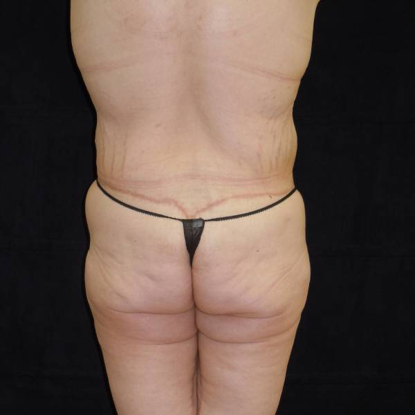 after body lift back view female patient case 4294