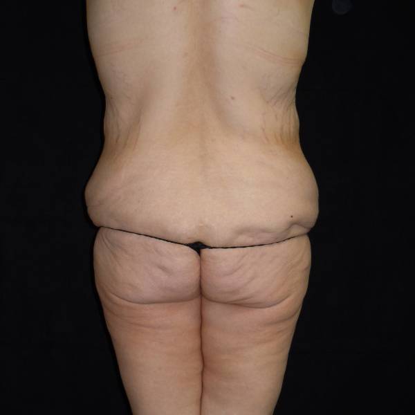 before body lift back view female patient case 4294