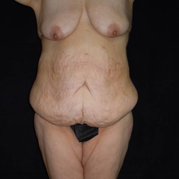 before body lift front view female patient case 4294