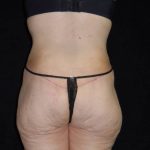 after body lift back view female patient case 4308