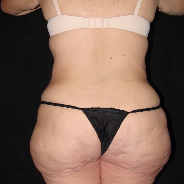before body lift back view female patient case 4308