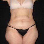 before body lift front view female patient case 4308