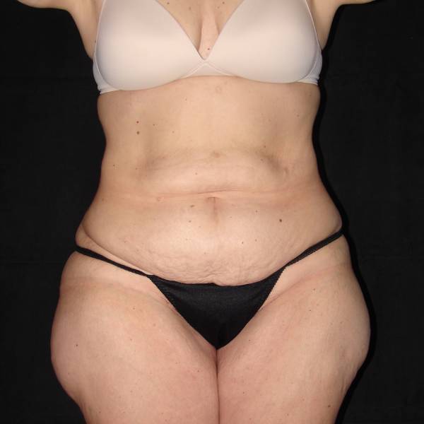 before body lift front view female patient case 4308