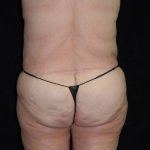 after body lift back view female patient case 4314