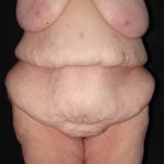 before body lift front view female patient case 4314